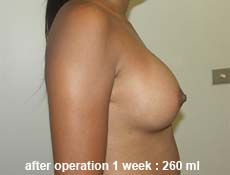 plastic-surgery-breast-augmentation 